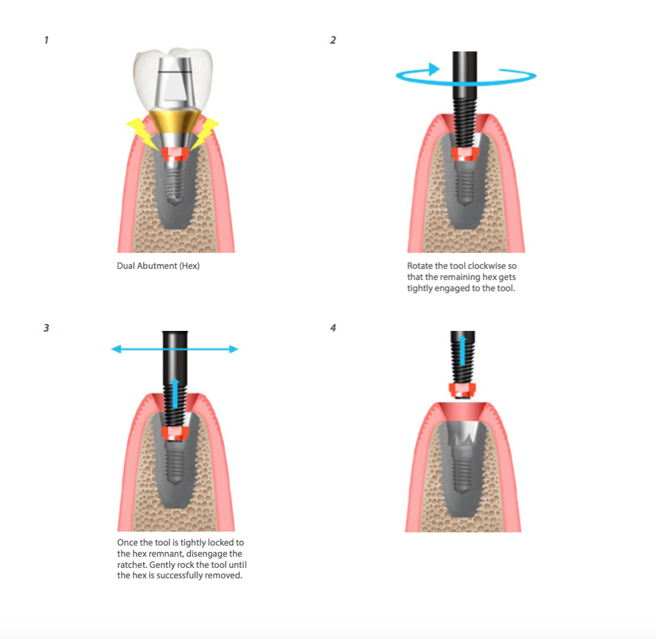 Help kit Dentium: Procedure Abutment Hex Remover Dentium