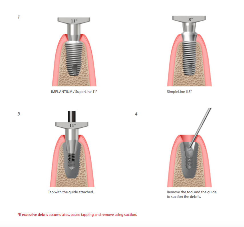 Help kit Dentium: LA PROCEDURE DEL SCREW TAP REPAIR DELLA DENTIUM