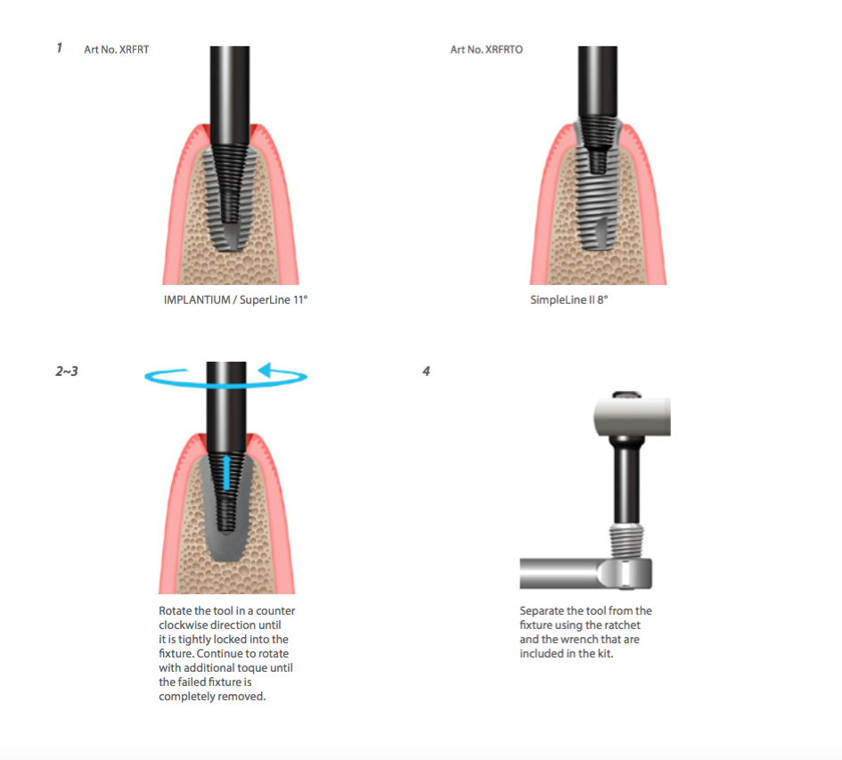 Help kit Dentium: LE PROCEDURE DEL FIXTURE REMOVER DELLA DENTIUM