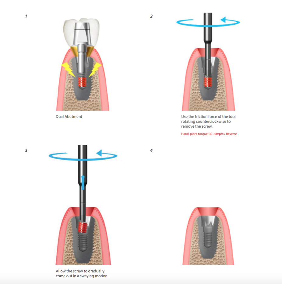 Help kit Dentium: Procedure Screw Remover dentium