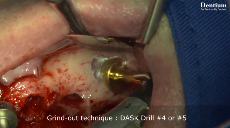 Partenza film DASK Dentium